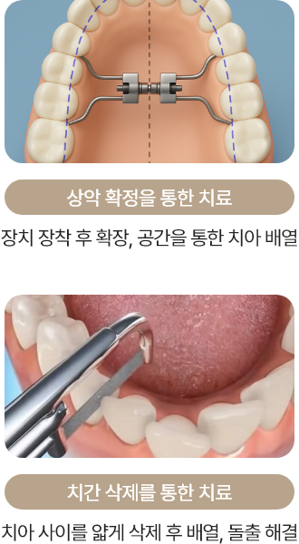 상악 확정을 통한 치료